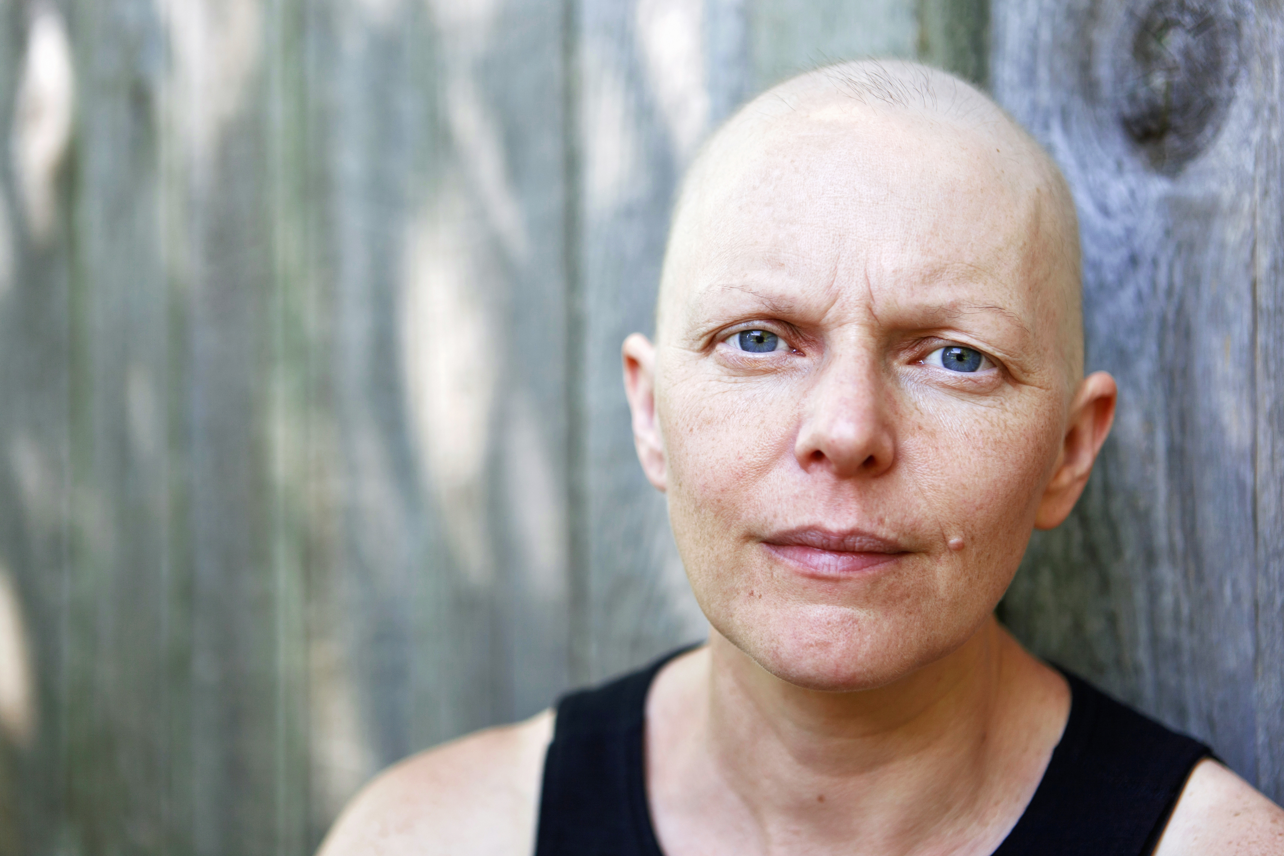 bald cancer patient from taxotere