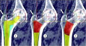 The Johnson & Johnson Depuy artificial hip implant