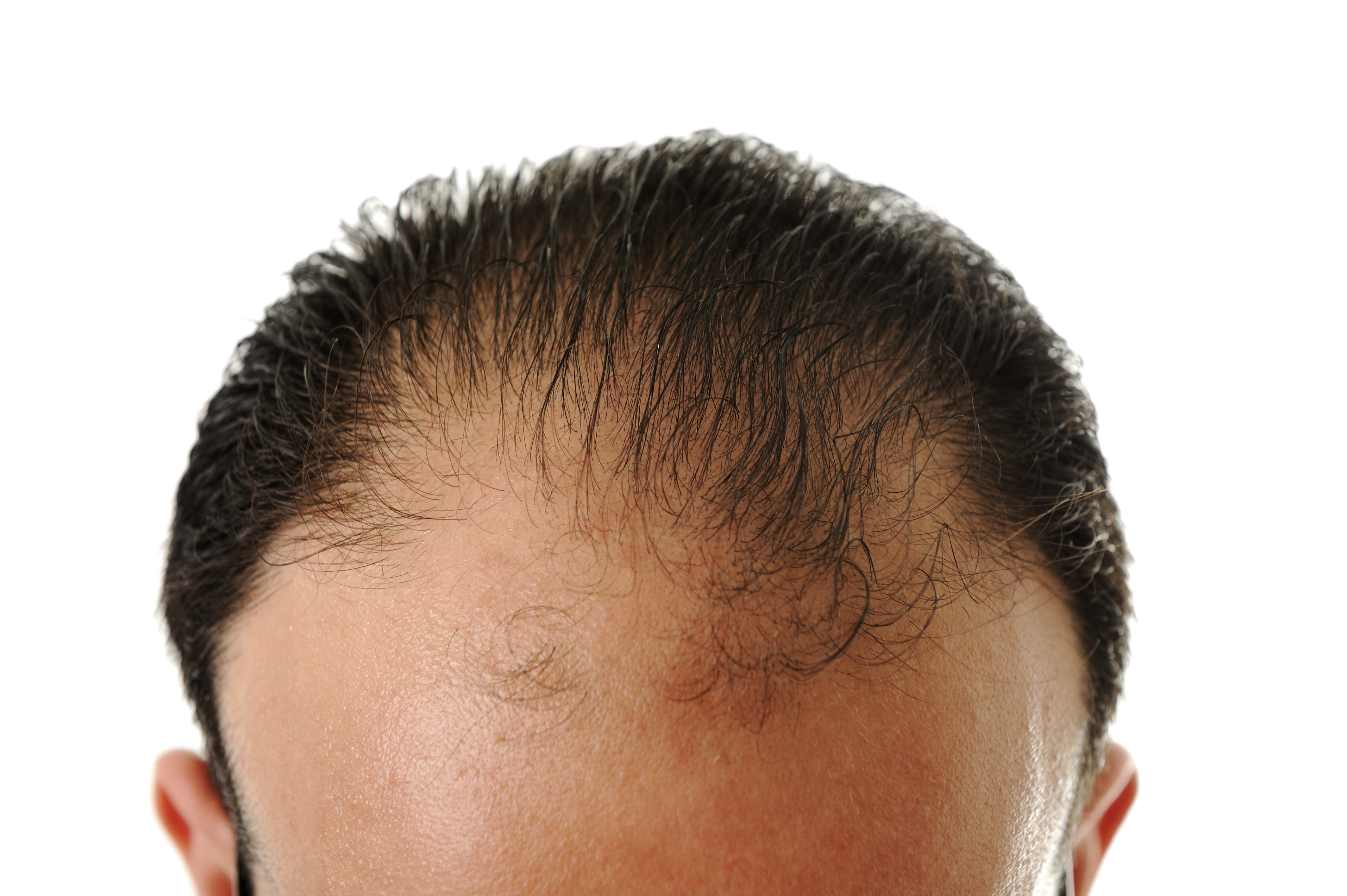 man experiencing male-pattern baldness