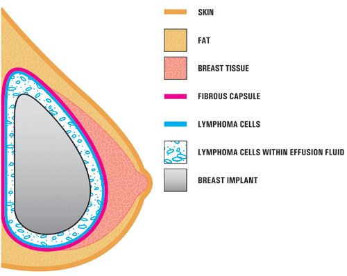 anaplastic large cell lymphoma diagram