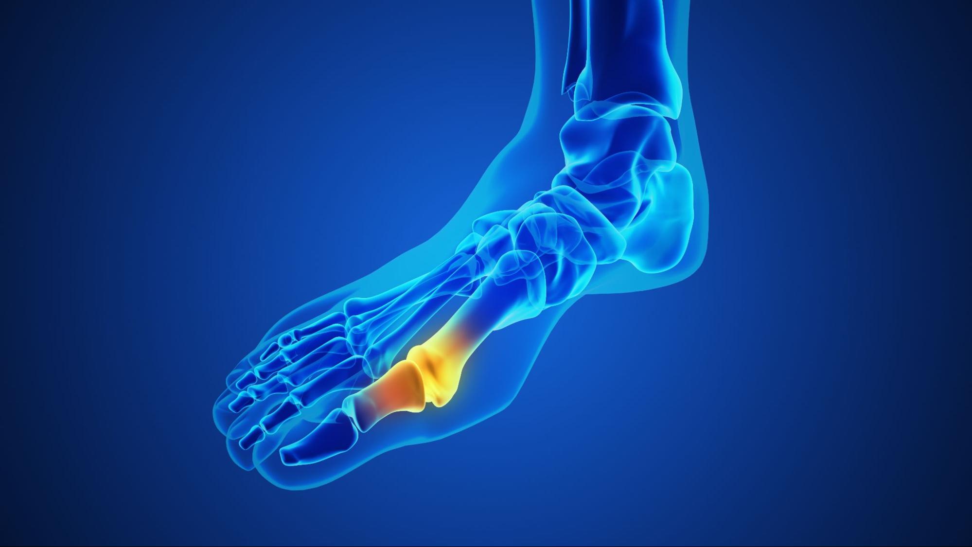 Painful gout inflammation on big toe joint.