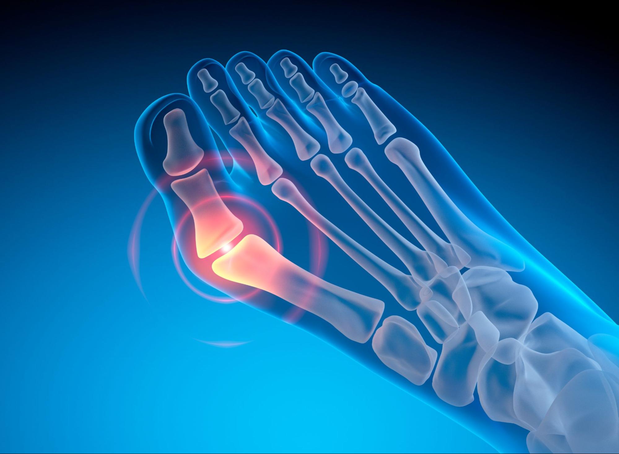 Hallux Valgus - Valgus deformity of the big toe - 3D illustration.